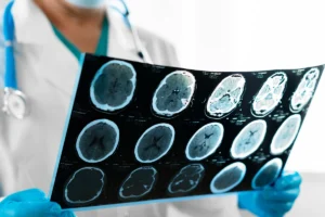 Brain Injuries from Low-Impact Collisions: What You Need to Know